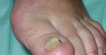 El tratamiento del hongo de las uñas a embarazado
